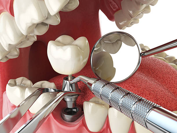 Best Emergency Root Canal Treatment in Mars Hill, NC